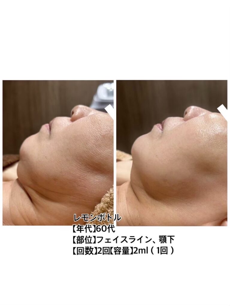 【60代女性 / フェイスライン・アゴ下/ 施術回数2回(レモンボトル2ml)】