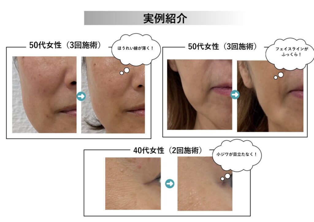 ソフトダーマの施術事例のご紹介