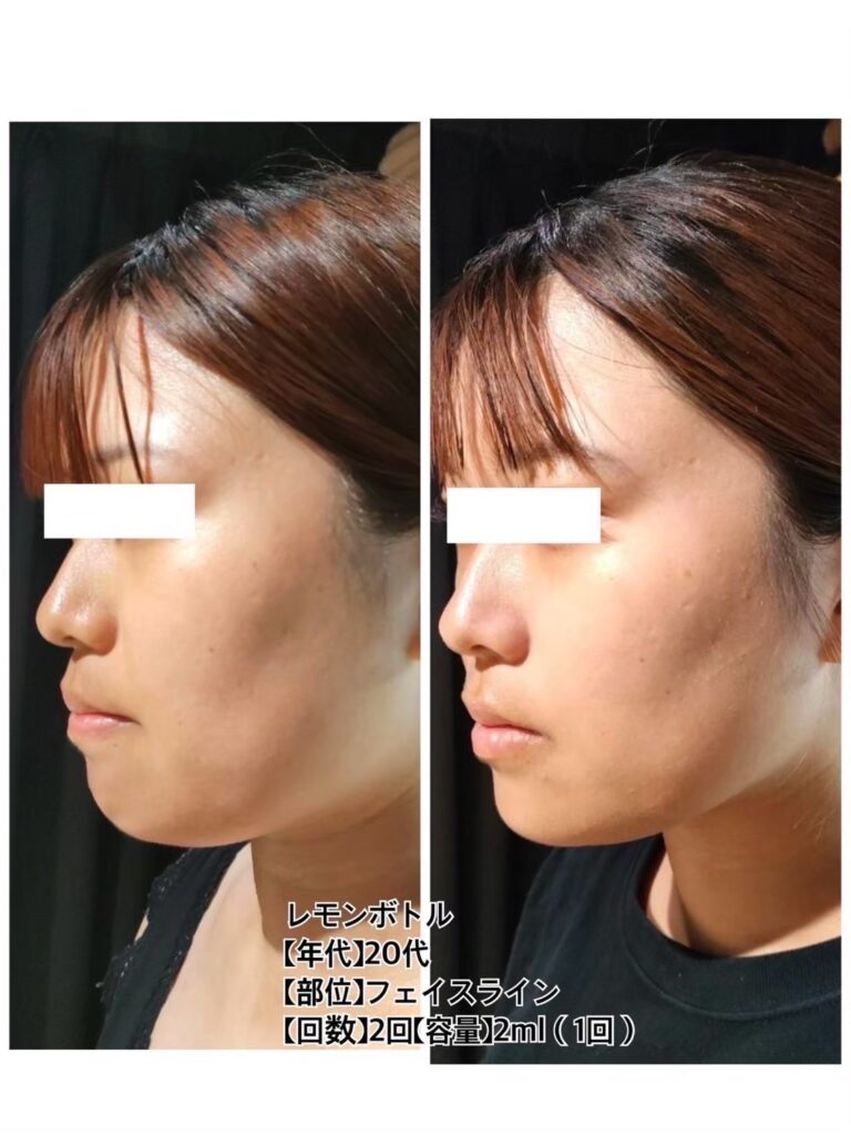 20代女性 / フェイスライン / 2回