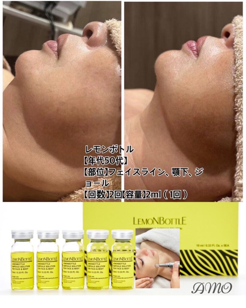 レモンボトルの施術事例のご紹介【50代女性 / フェイスライン・顎下・ジョール / 2回(2ml)】